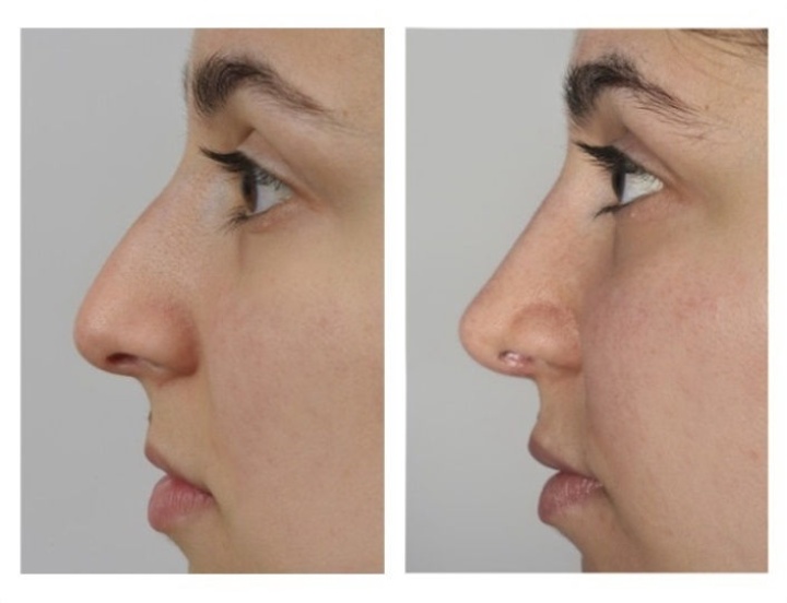 For many patients the ideal nose correction: the tip has just a little more projection than the nose.