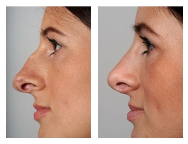Correctie van een aangeboren onderontwikkeling van de linker zijde van de neus met behulp van een kraakbeen transplantaat op de neuspunt.