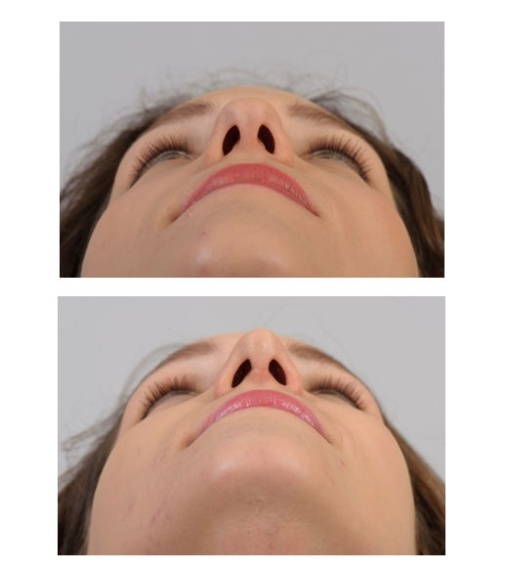 Narrowing of the wide (bifide) split nose tip.