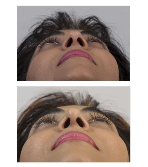 Correction to make a narrower and rounder nose tip.