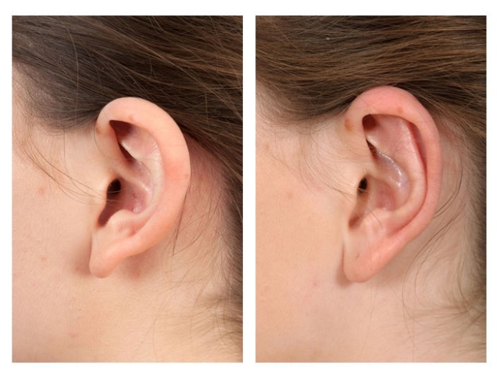 Bij veel oorcorrecties gaat het om het creëren van de  kraakbeenplooi, die hier op de rechter foto goed te zien is