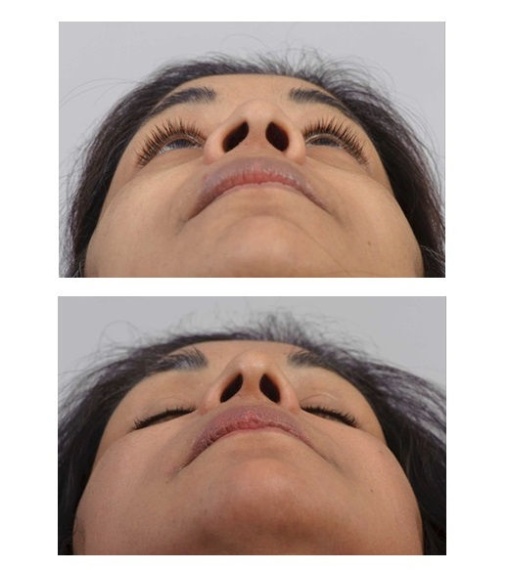 Verkleinen van de neusgaten middels verkleinen van de neusvleugels (ala reductie).
