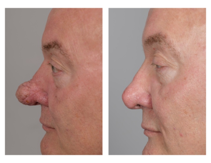 Correctie van de neuspunt door shave van de verdikte huid (chronische ontsteking van de talgklieren).