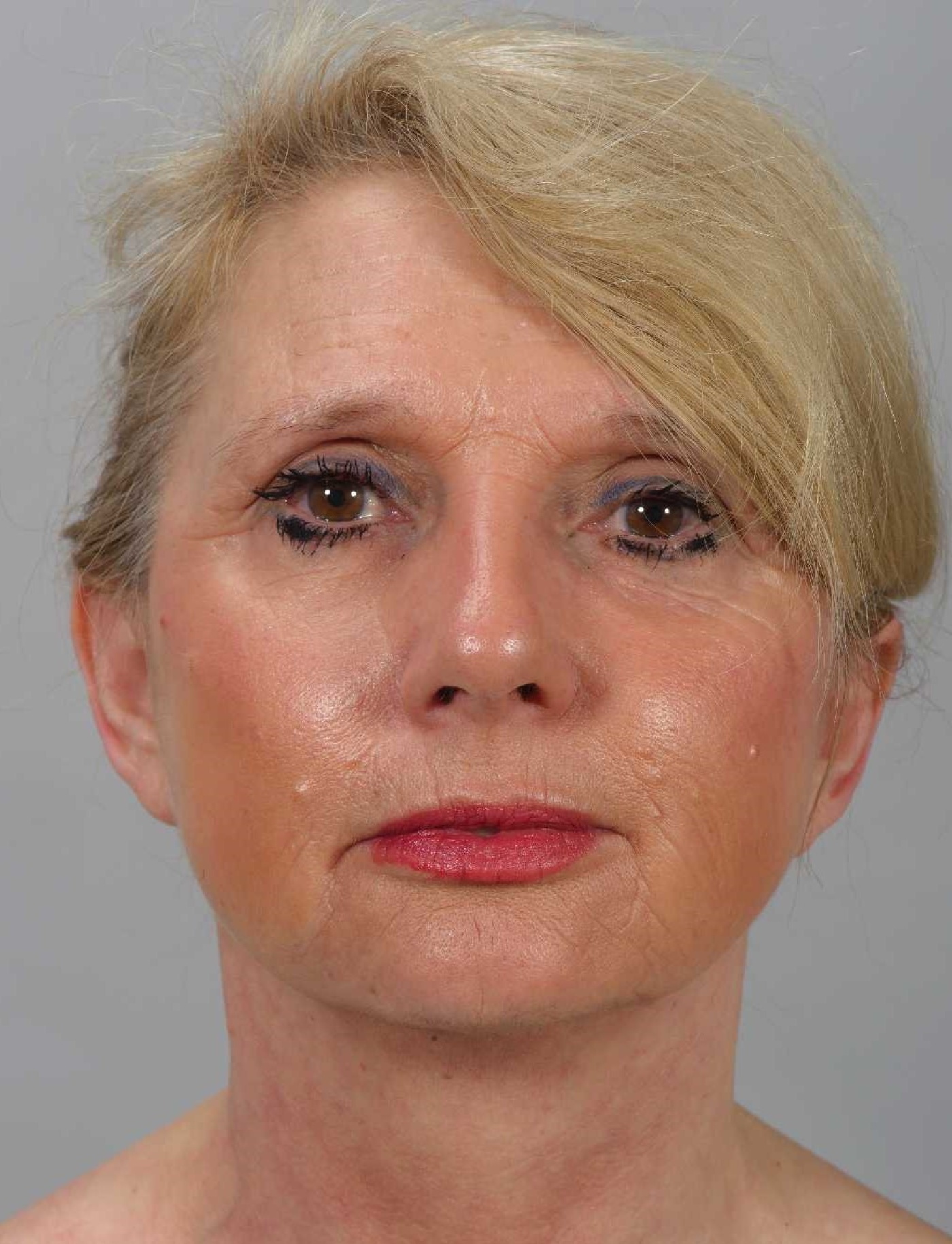 Volume restoration, correction of the jawline and improvement of the skin