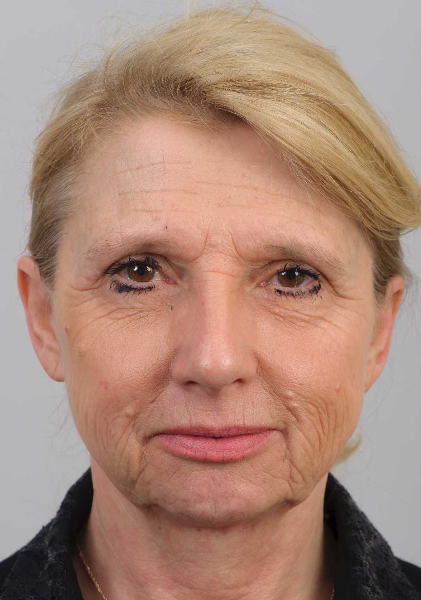Volume restoration, correction of the jawline and improvement of the skin