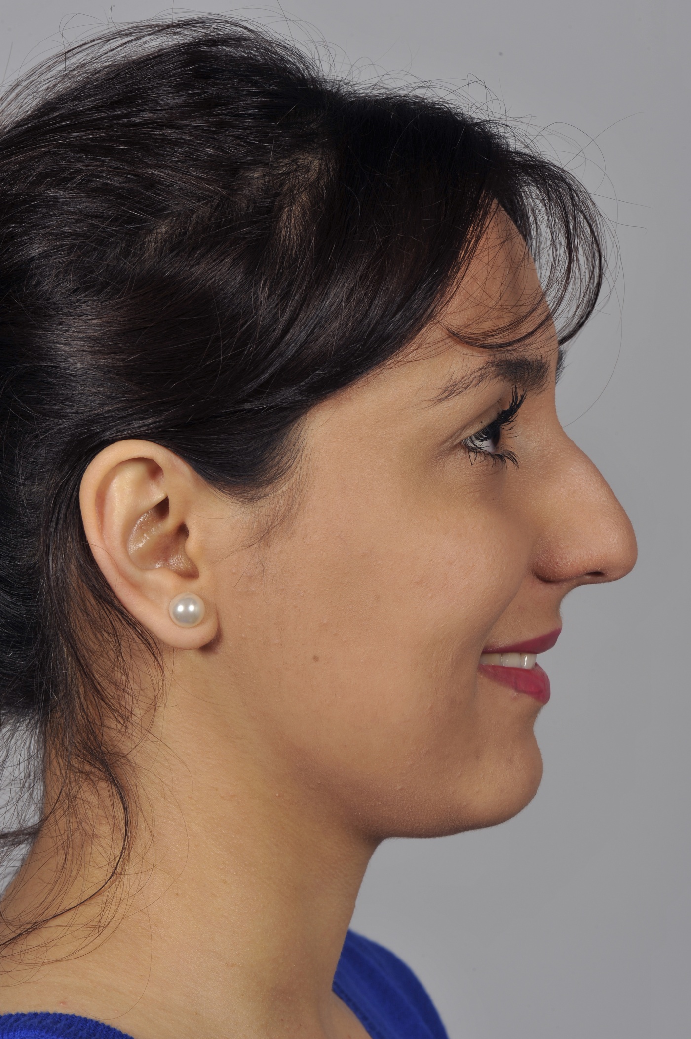 After correction, the tip of the nose is no longer pulled down when smiling