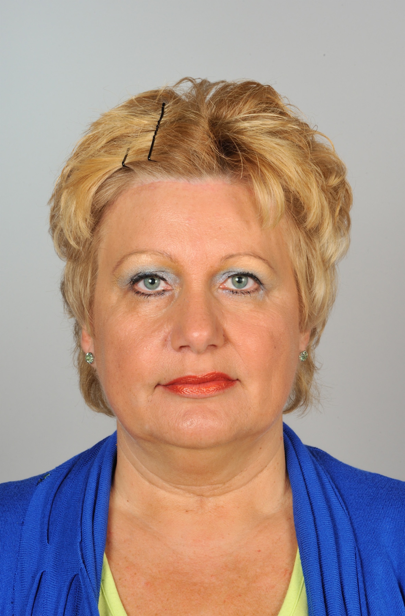 Significant elevation of the forehead and brows