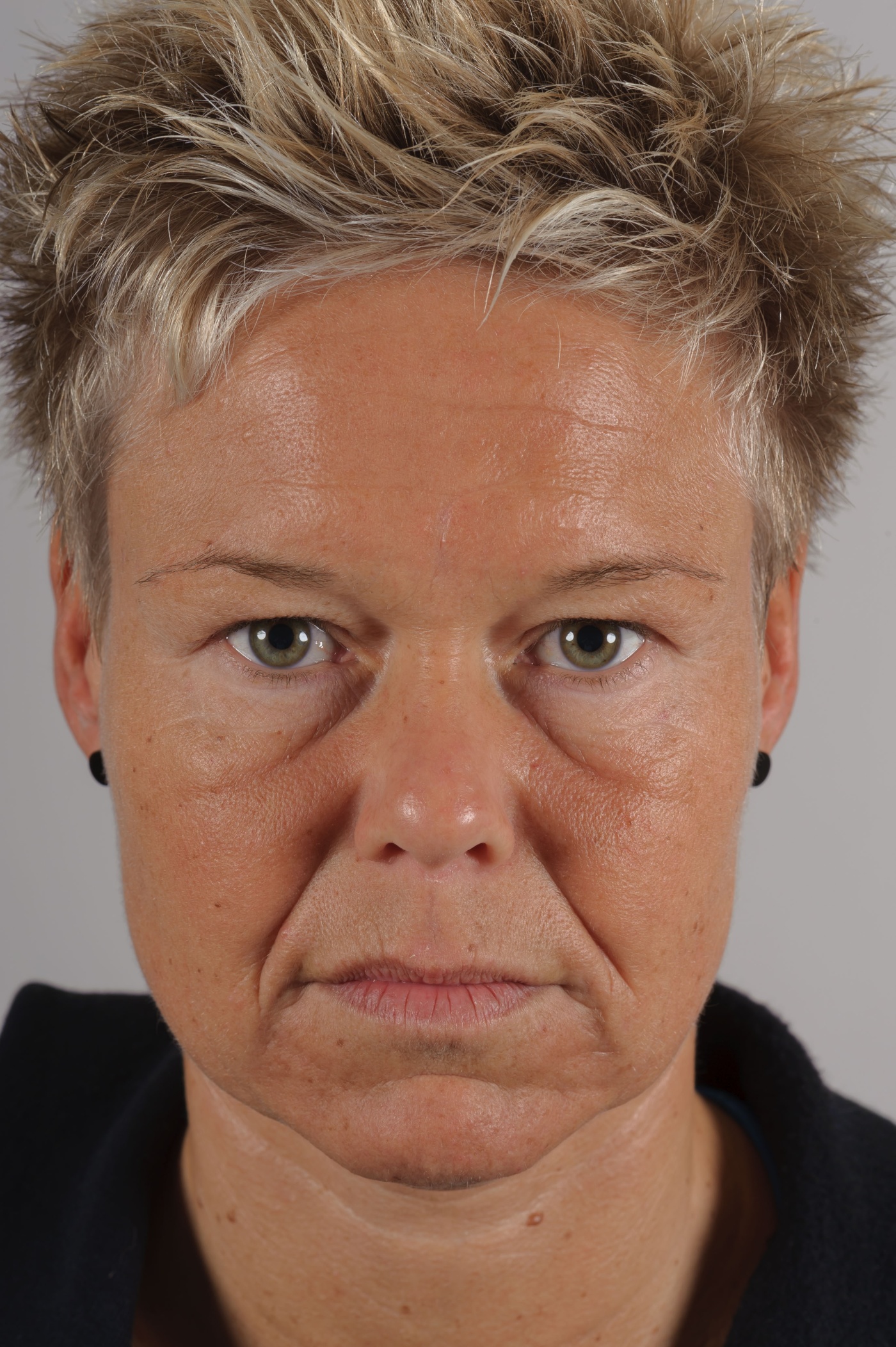 Improvement of the eyelids after forehead lift