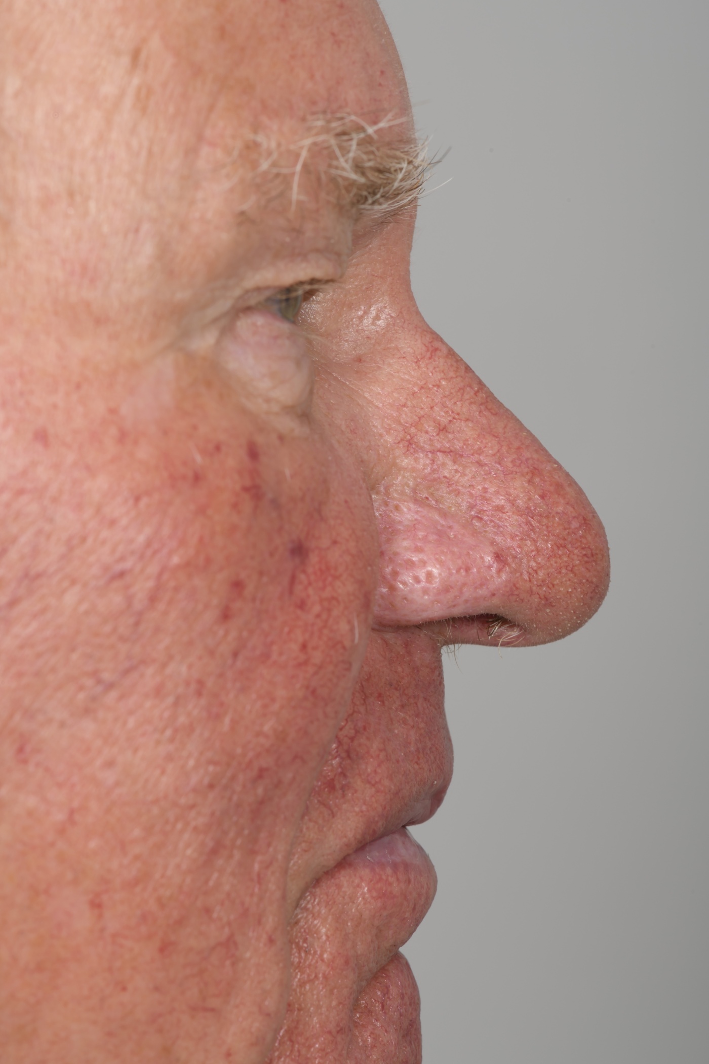 Rhinophyma van de neusvleugels