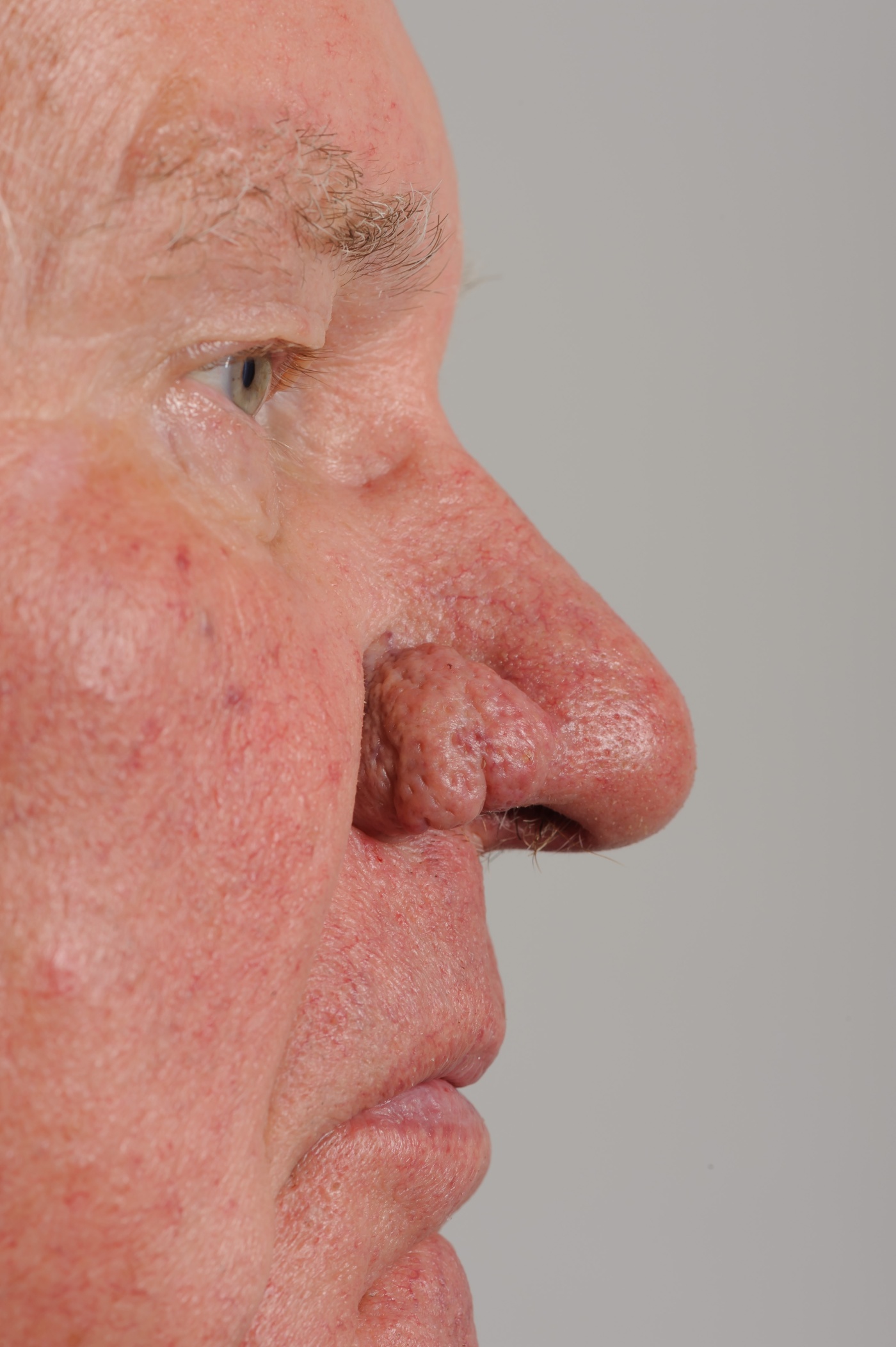 Rosacea and rhinophyma of the nose