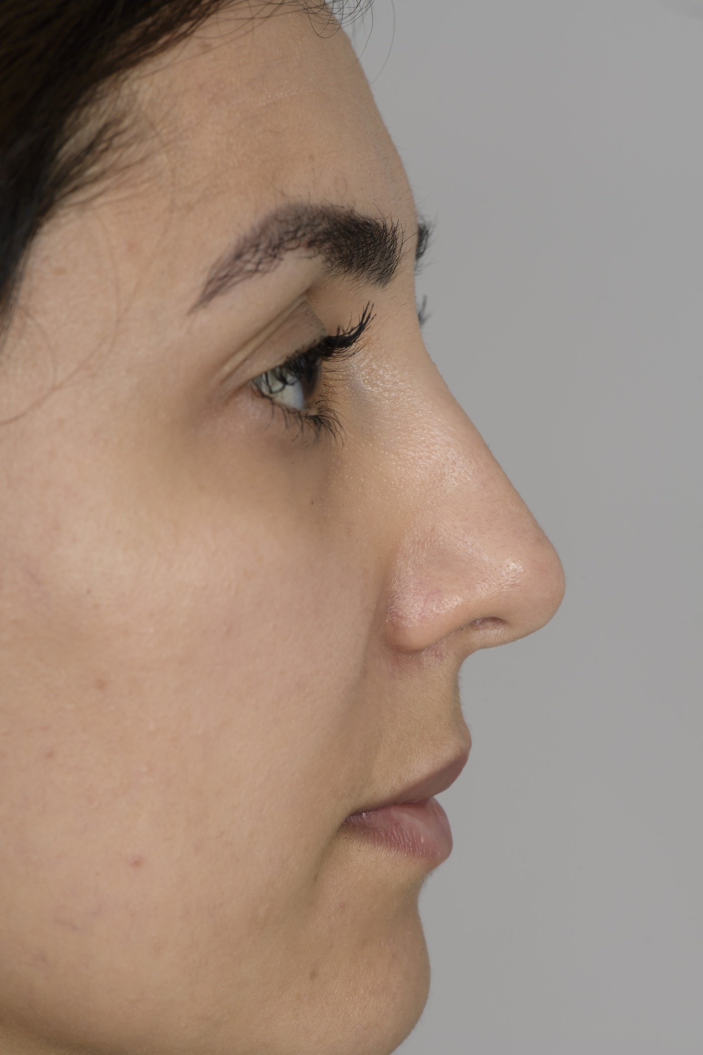 Verlagen en versmallen van de benige en kraakbenige neusrug en verfijnen van de punt