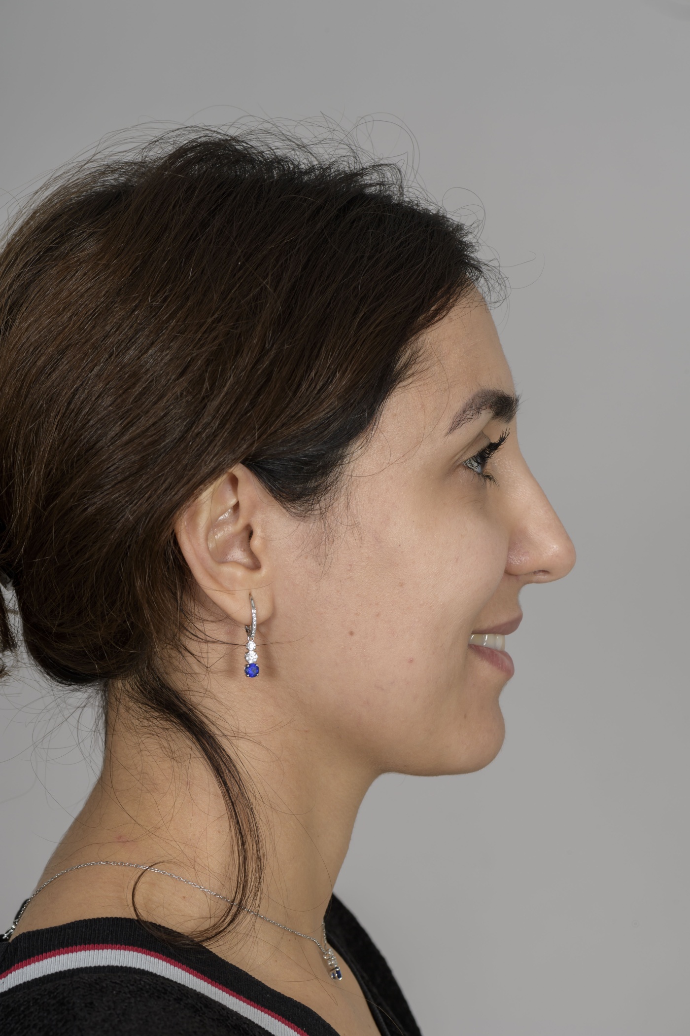 After correction, the tip of the nose is no longer pulled down when smiling