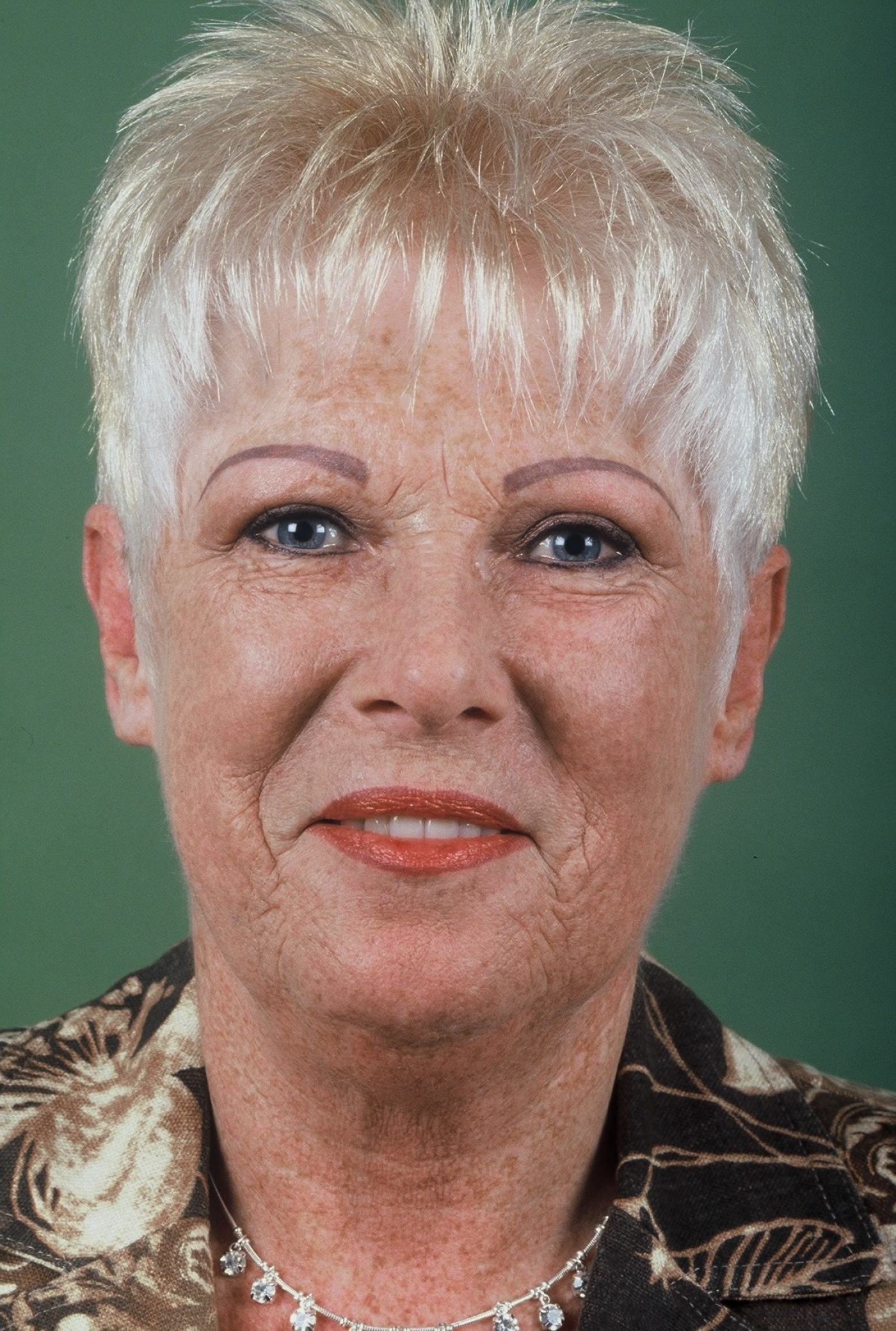 Correction of protruding ears and earlobes
