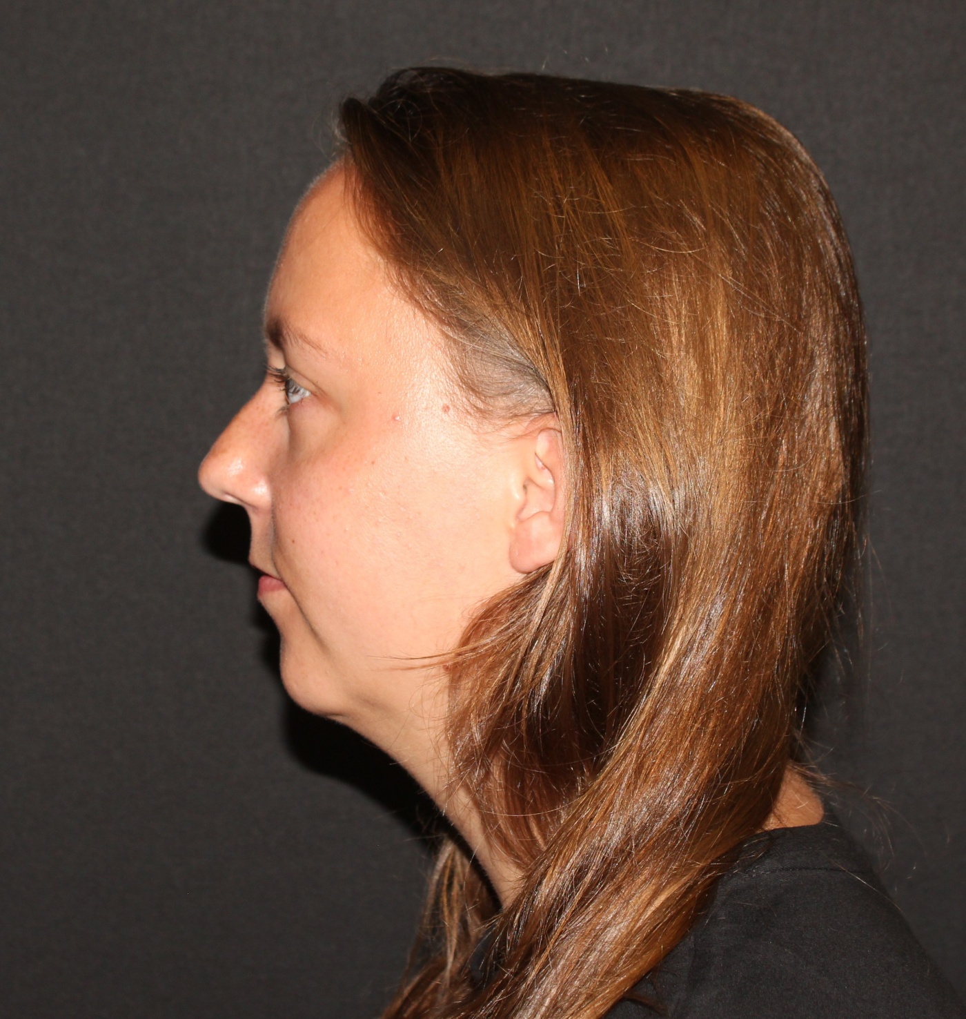 Chin implant and liposculpture of the neck