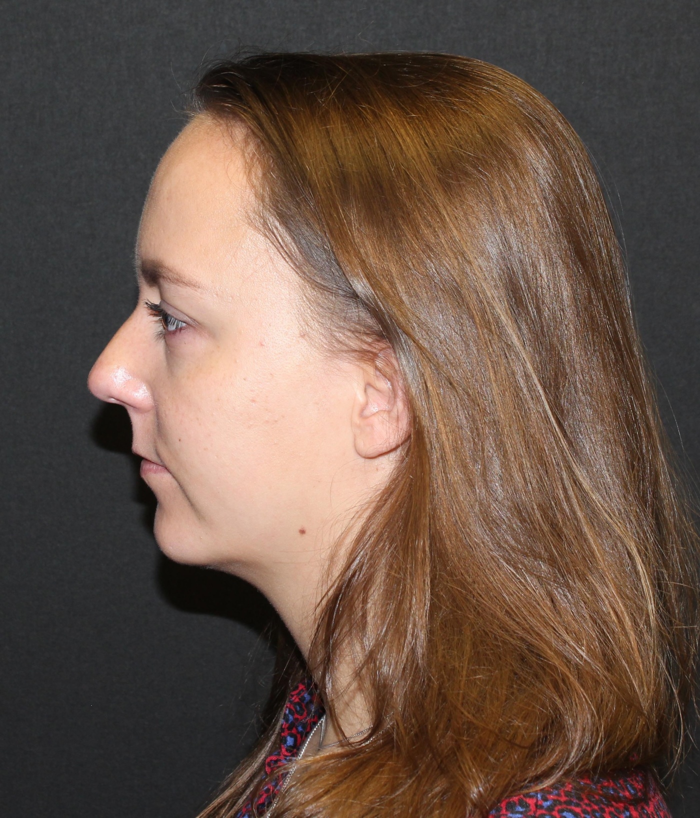 Kin-vergroting met een implantaat en (beperkte) liposuctie van de hals, waardoor ook de contour van de hals verbetert