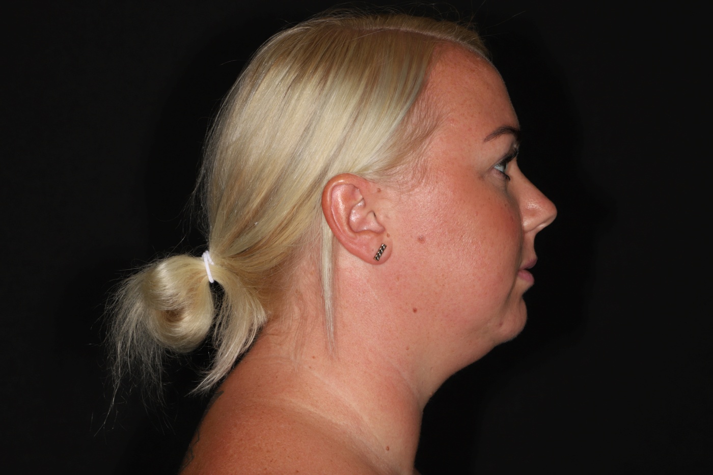 Chin implant and contouring of the neck by liposuction