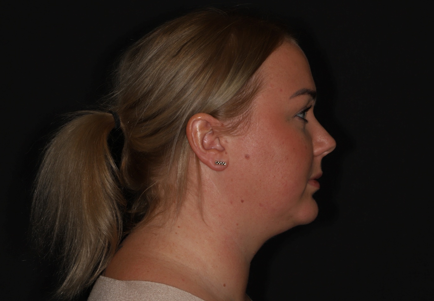 Chin implant and contouring of the neck by liposuction