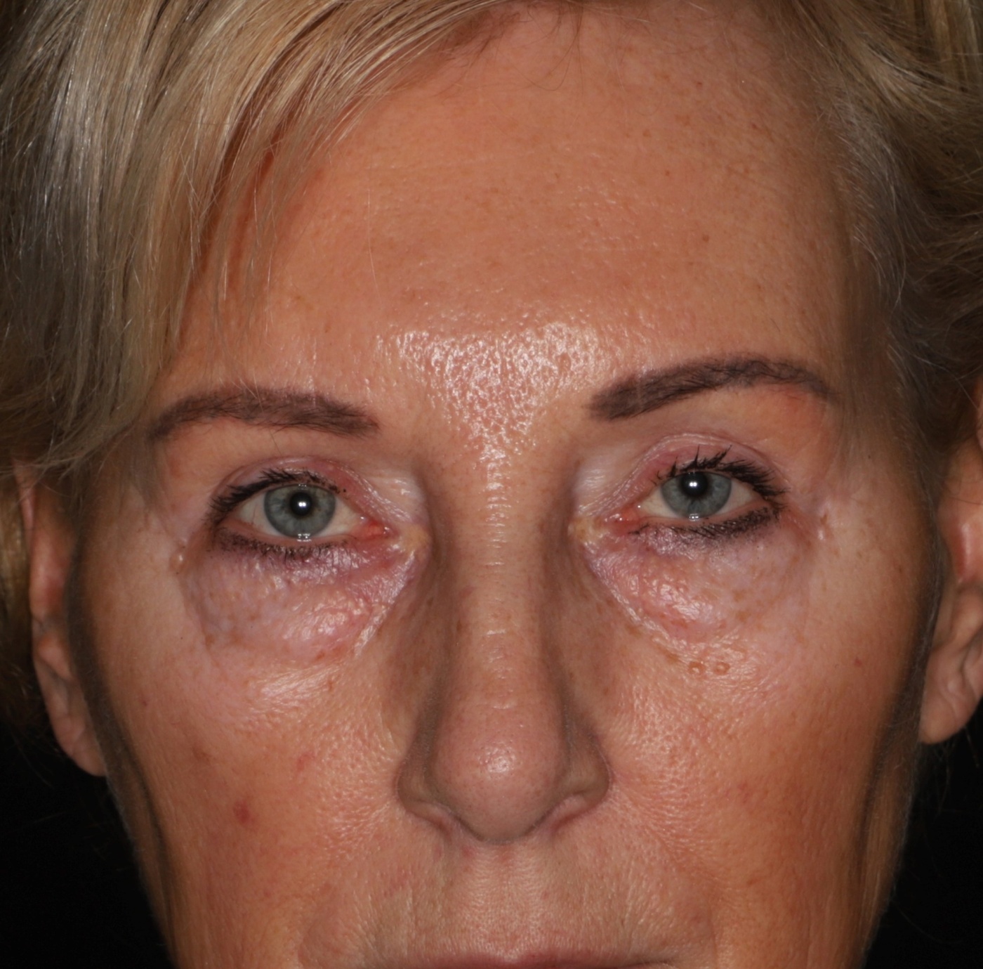 Reduction of the bags of the lower eyelid