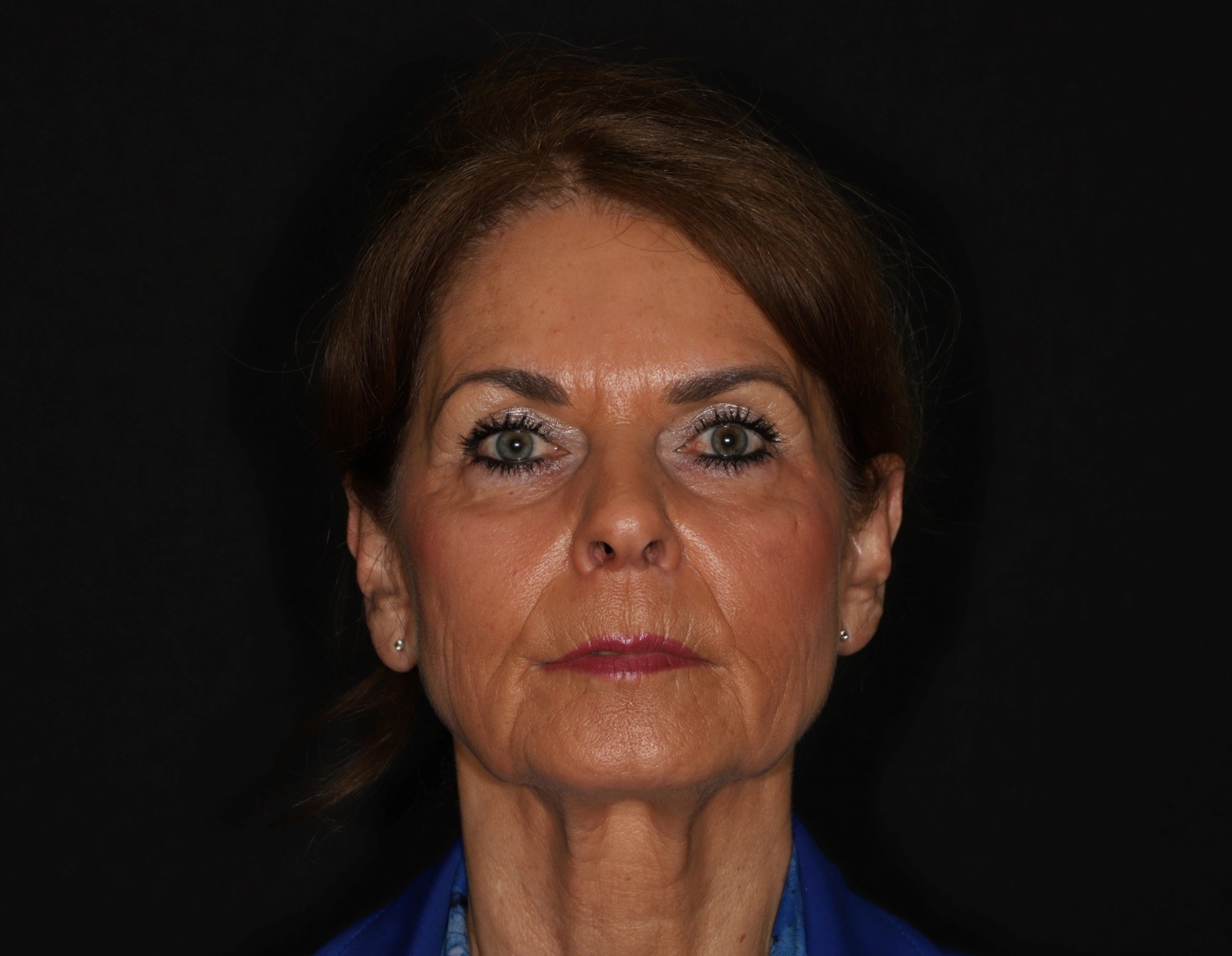 Toename van volume in het gezicht na de facelift