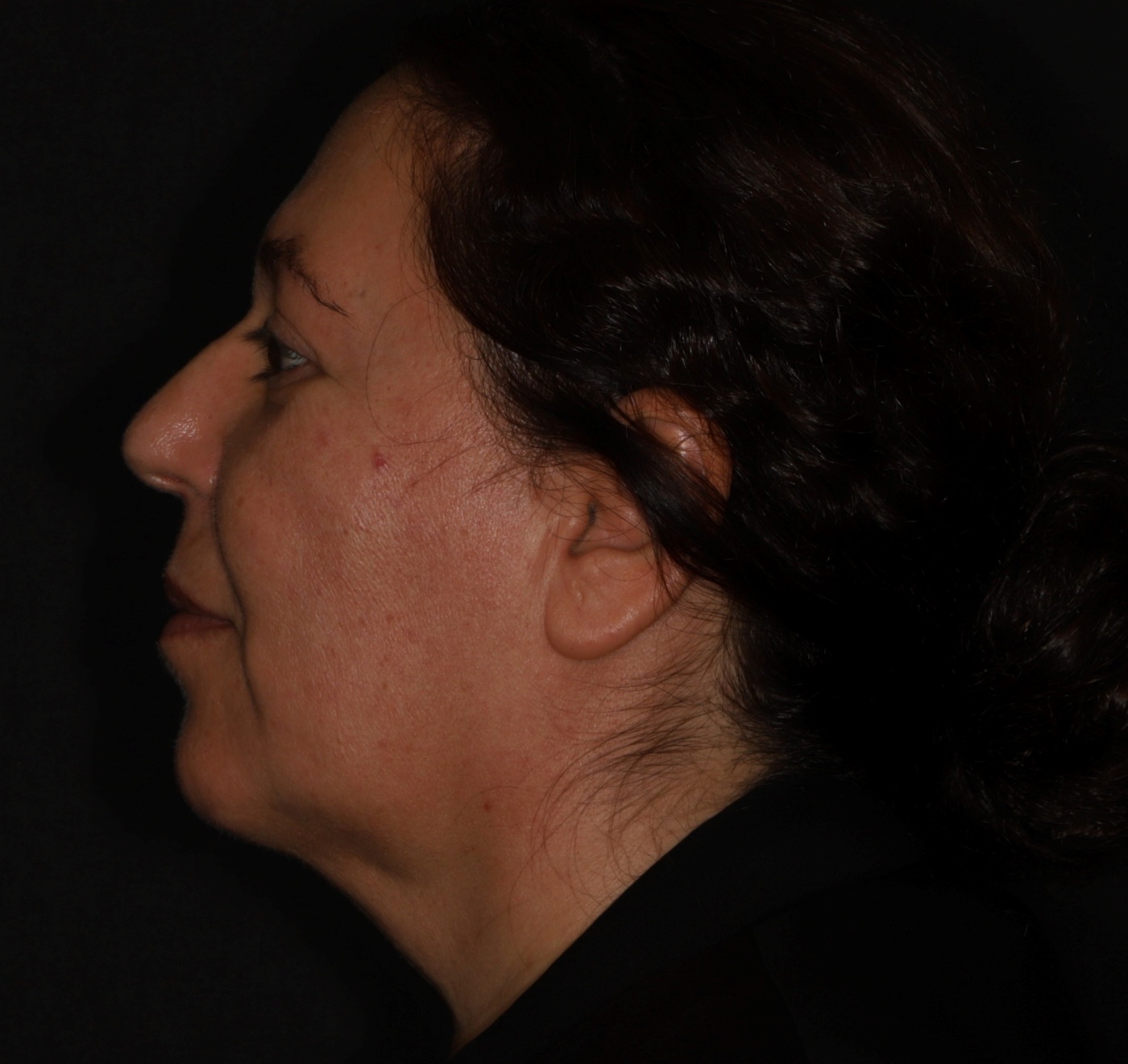 In some cases the contour of the neck can be improved by liposuction. This treatment is often combined with a facelift.