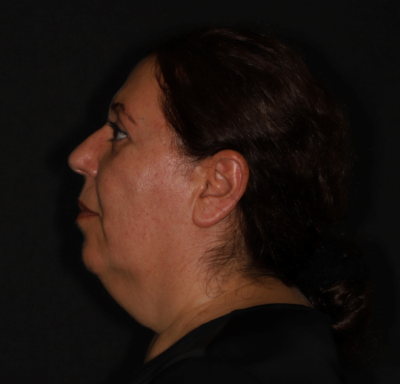 In some cases the contour of the neck can be improved by liposuction. This treatment is often combined with a facelift.