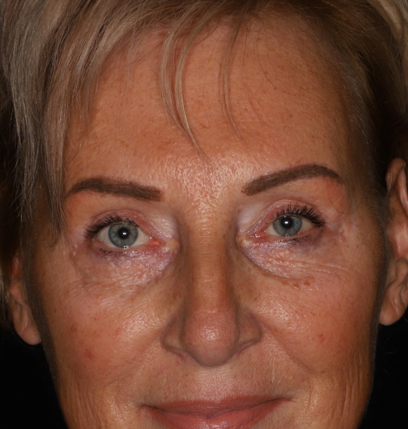 Reduction of the bags of the lower eyelid