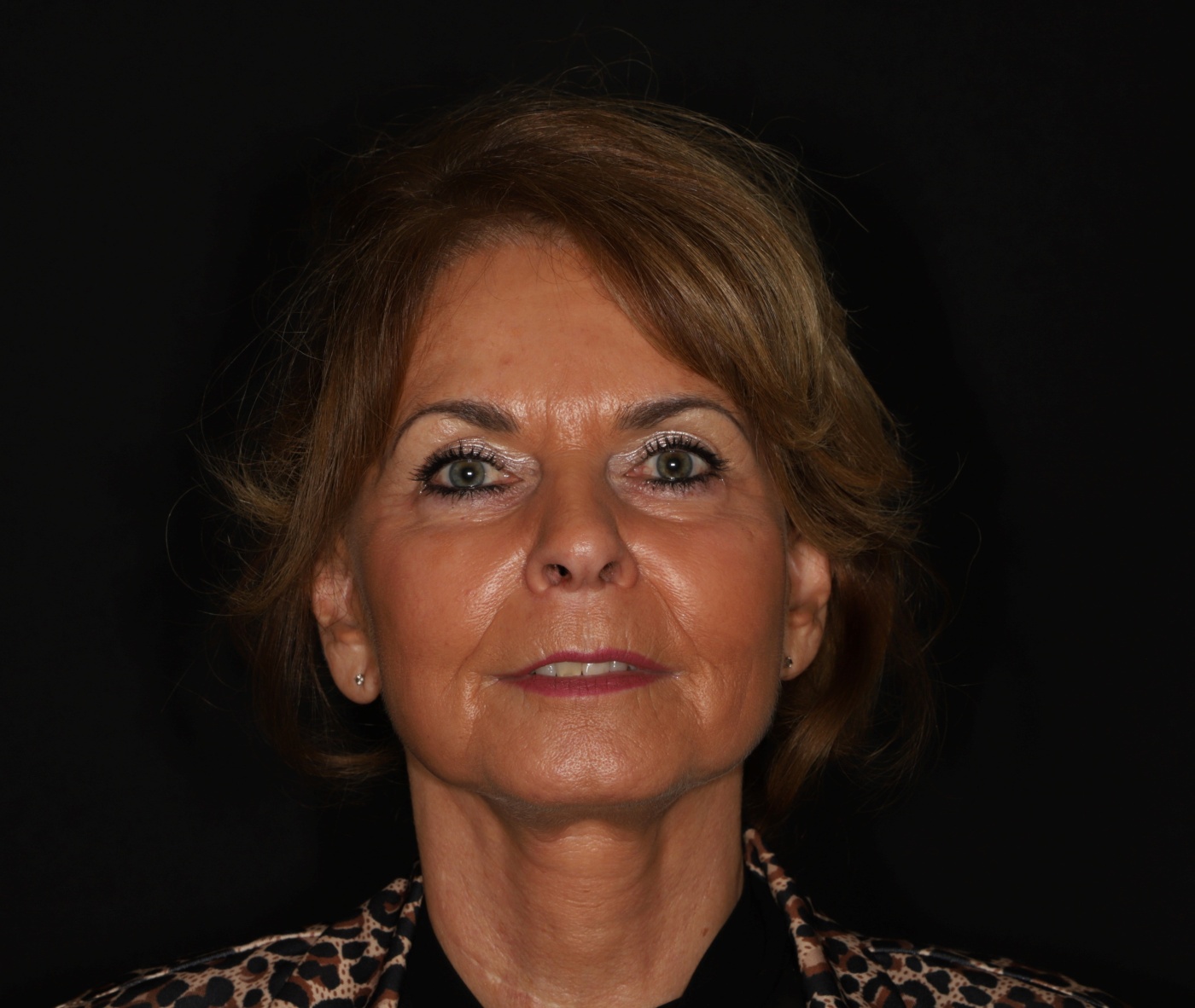Toename van volume in het gezicht na de facelift
