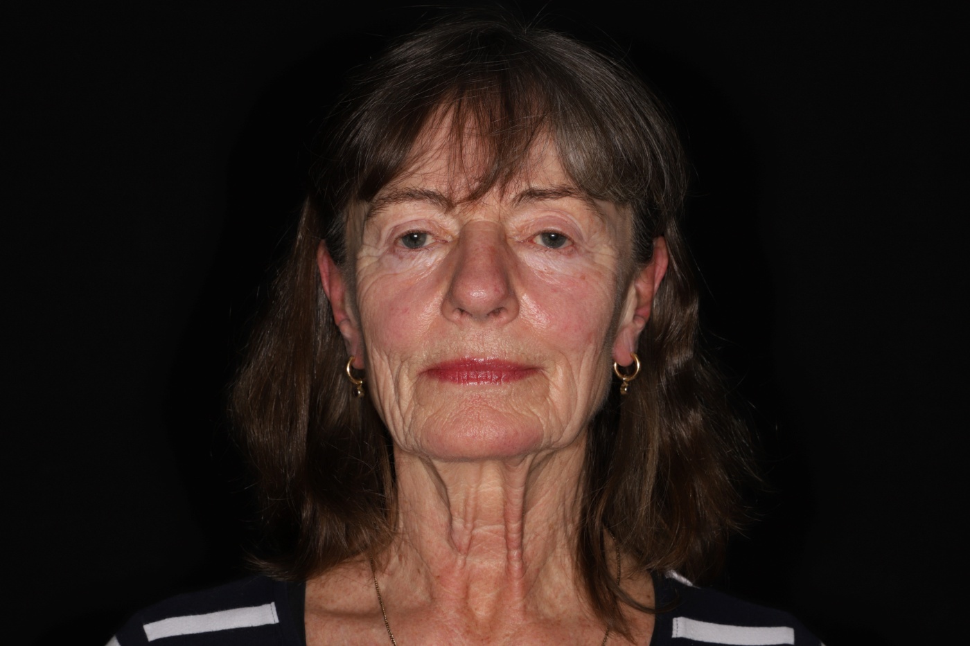 Facelift en verbetering van de hals