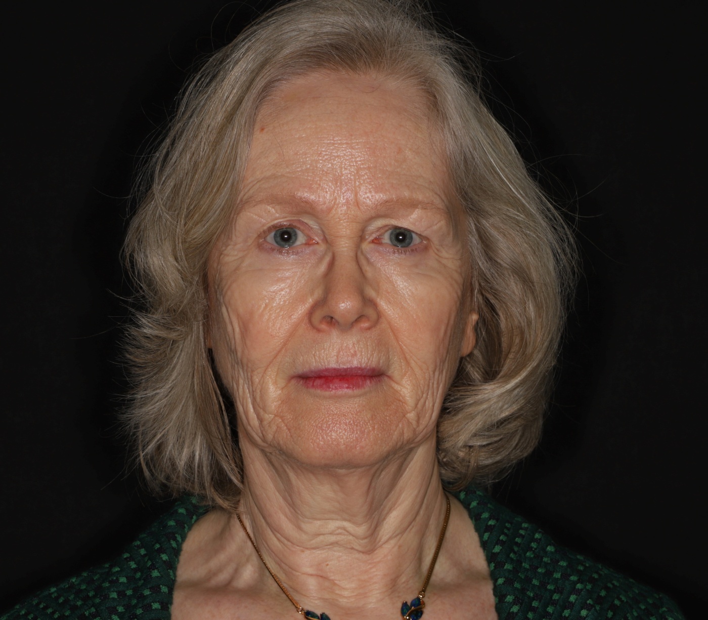 Restoration of volume, of the jawline, of skin texture en improvement of the neck