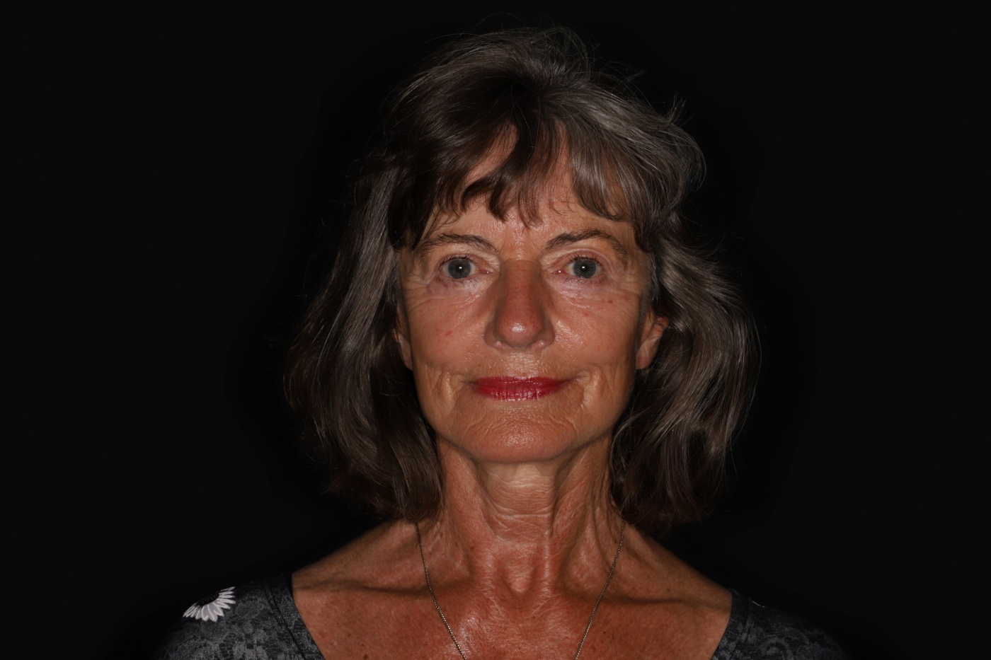 Facelift en verbetering van de hals