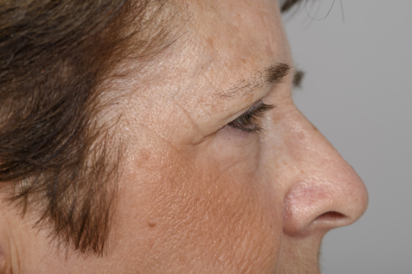 Lateral view of a browlift