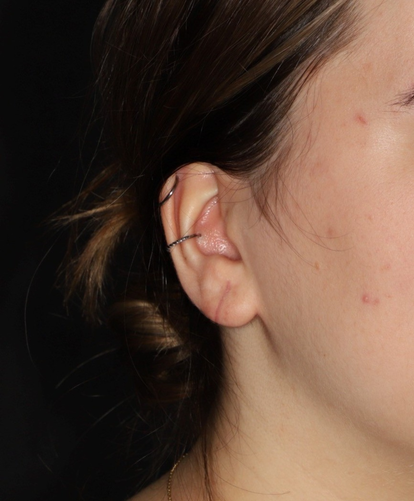 Correction of a protruding earlobe