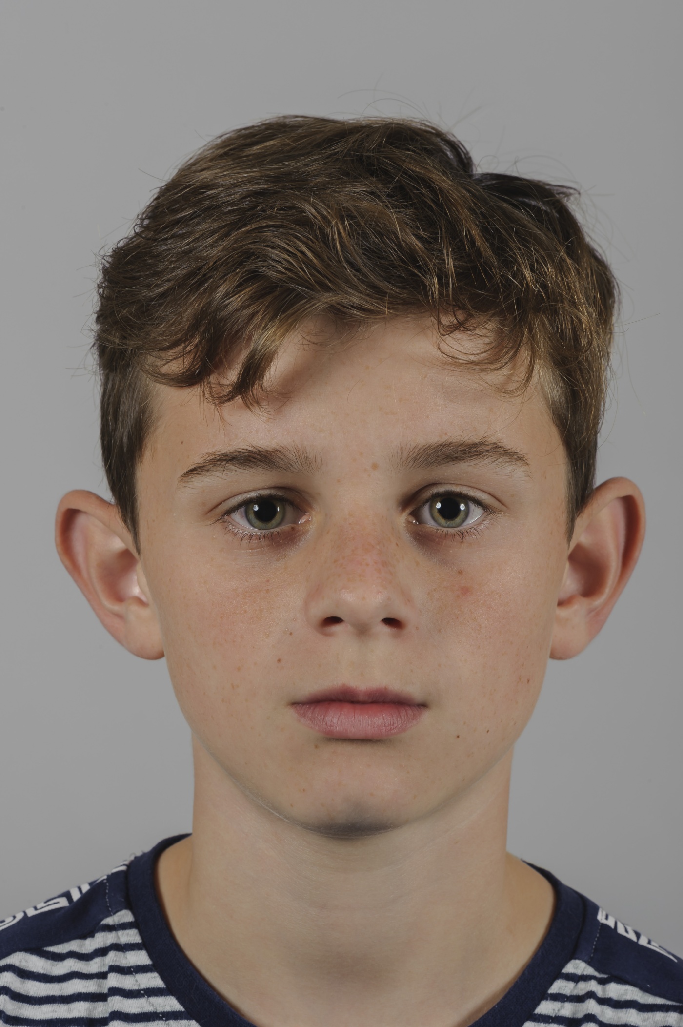 Correction of protruding ears