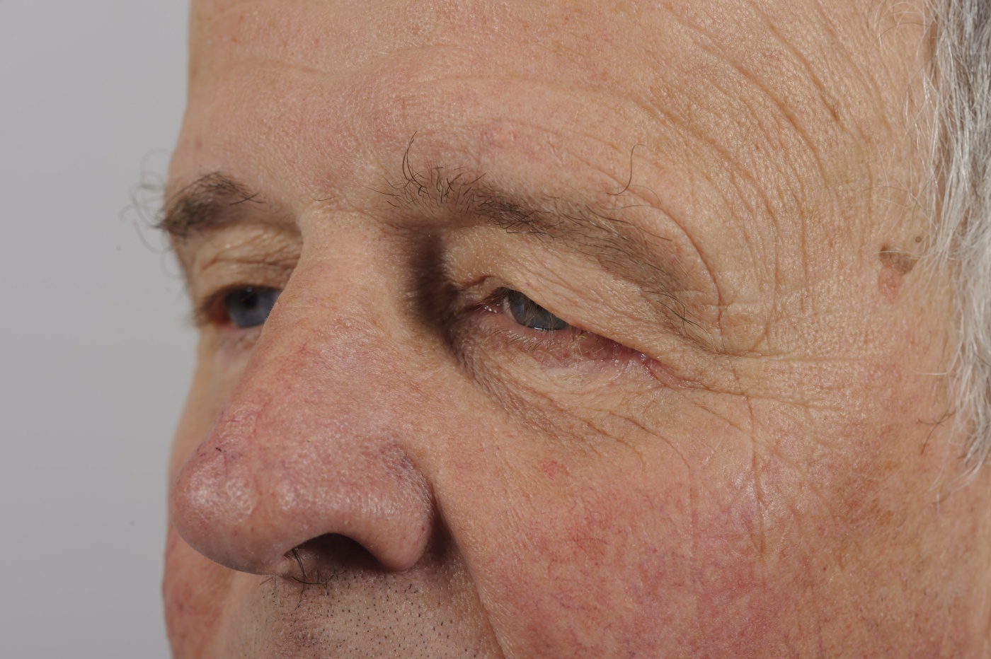 Limited or direct browlift of the left brow (with the scar in the upper outer margin)