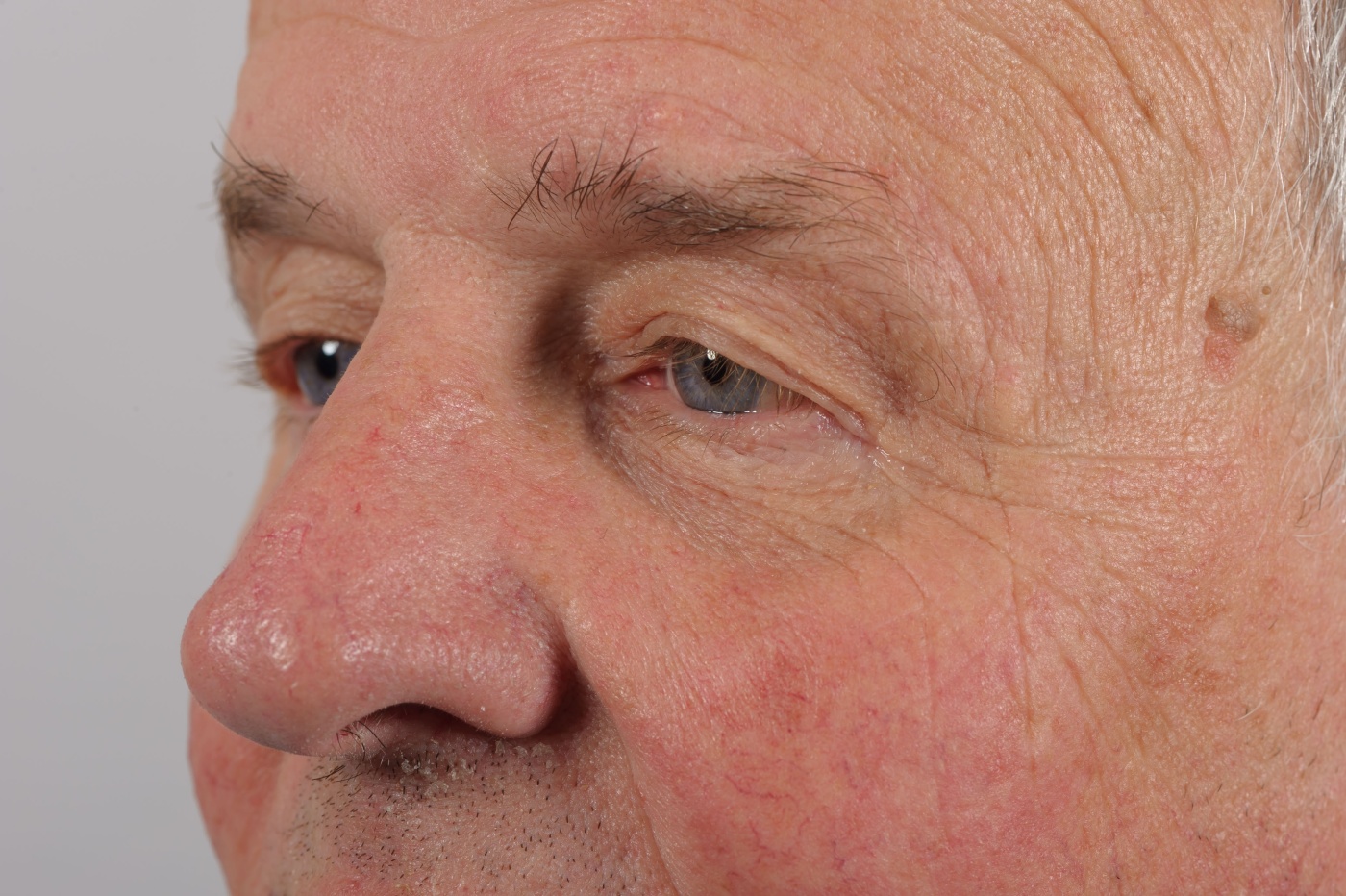 Limited or direct browlift of the left brow (with the scar in the upper outer margin)