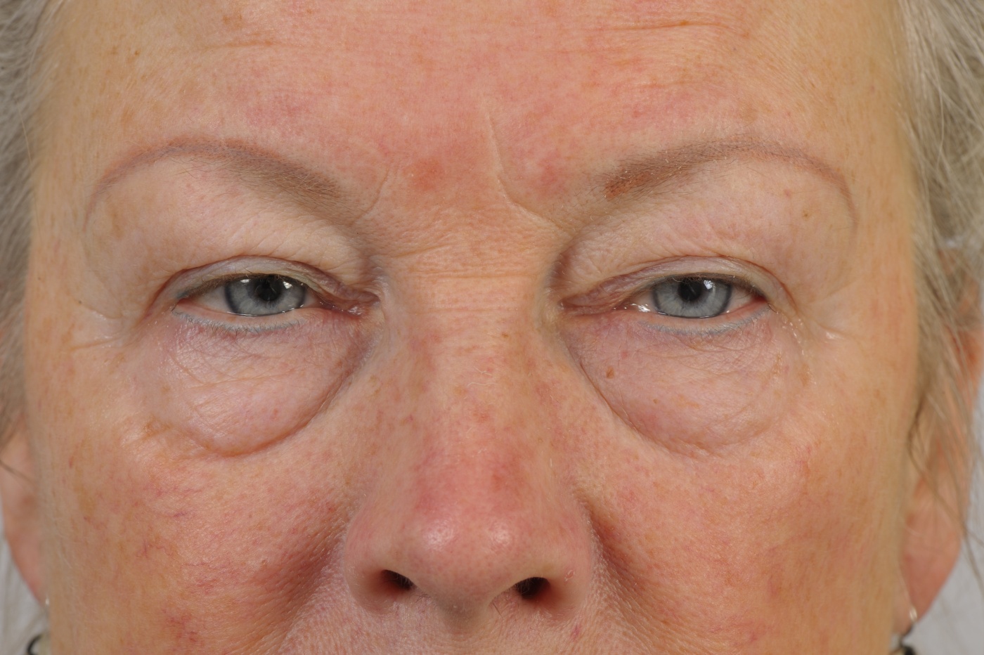 The dark circles are caused by the shadow of the bags in de lower eyelids