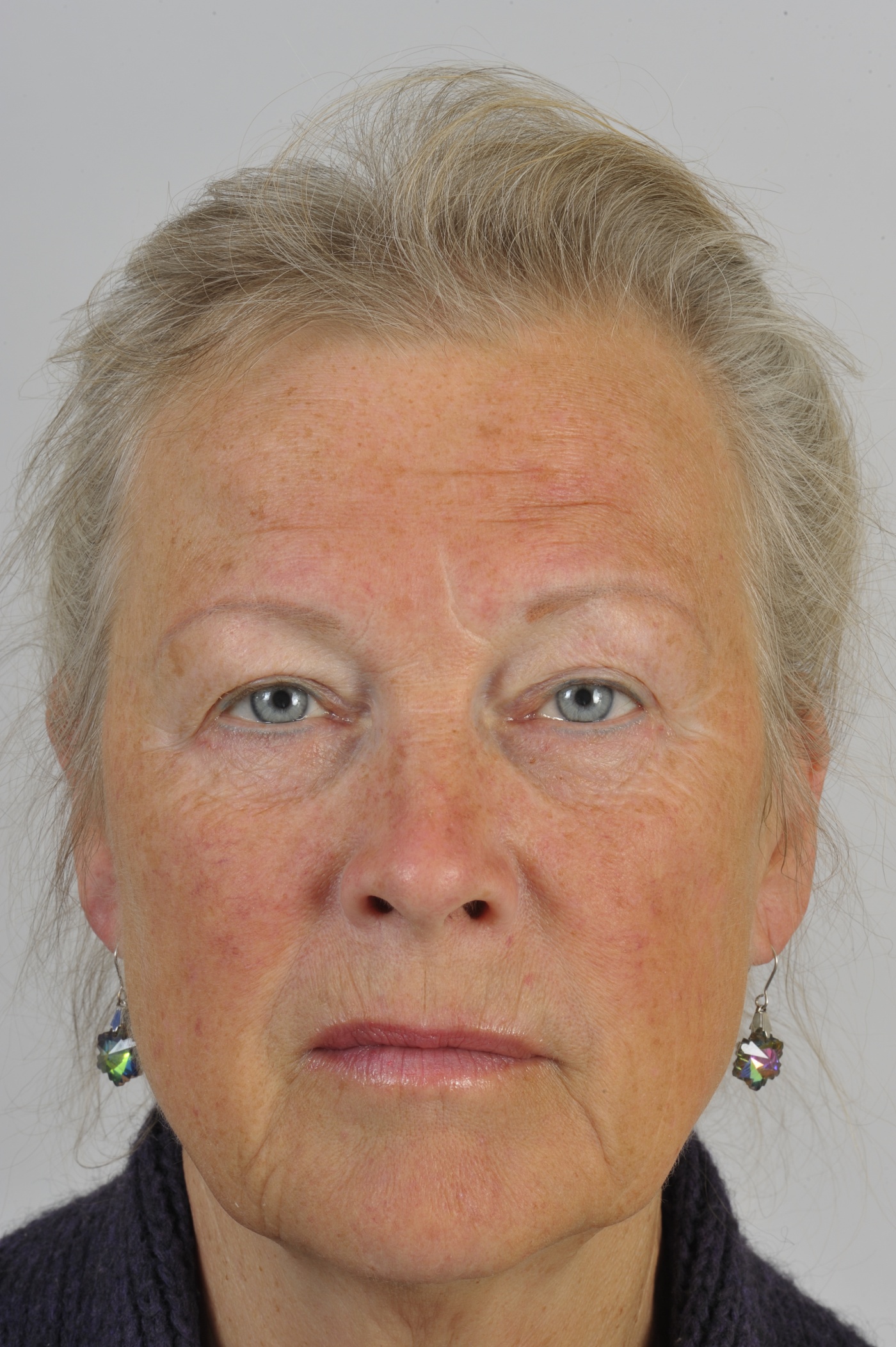 Correction of the upper and lower eyelids