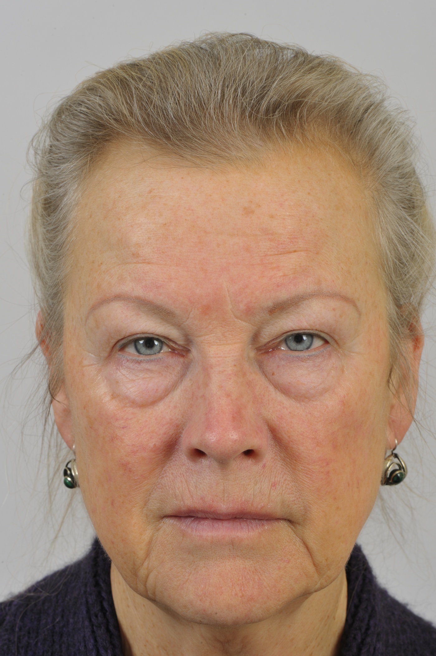 Correction of the upper and lower eyelids