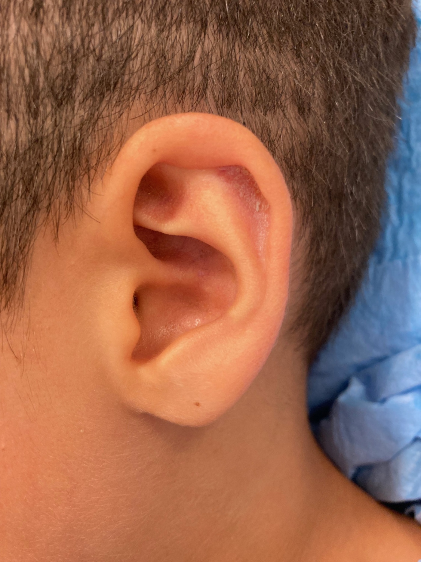 Correction of the edge of the auricle