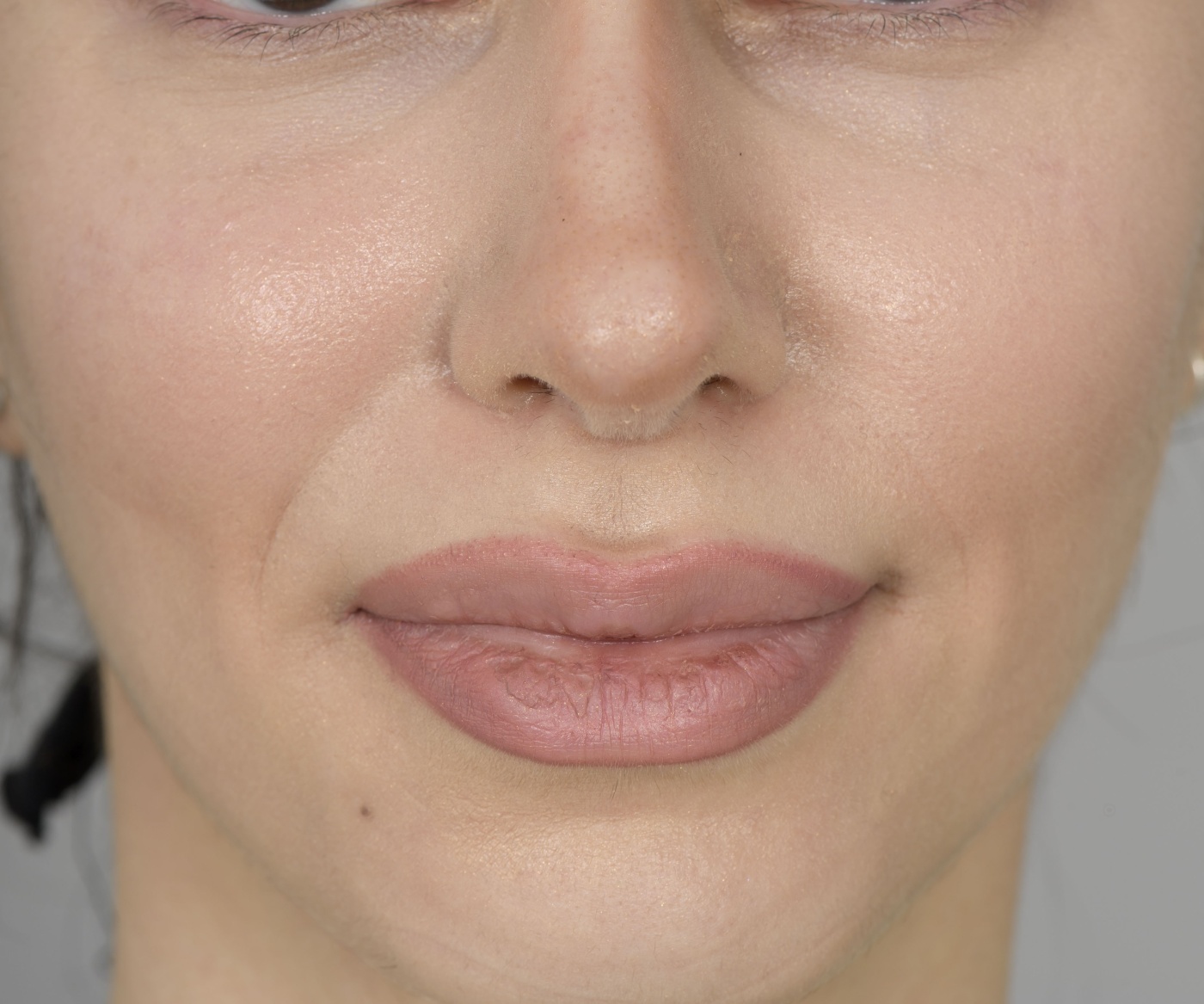 Reduction of the tip of the nose