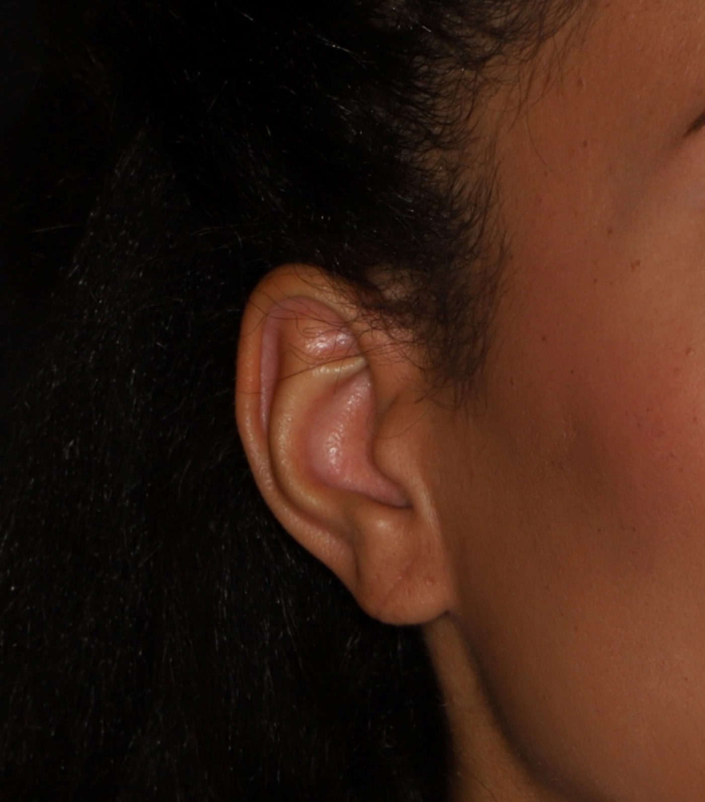 Correctie/reconstructie oorlel (close-up)