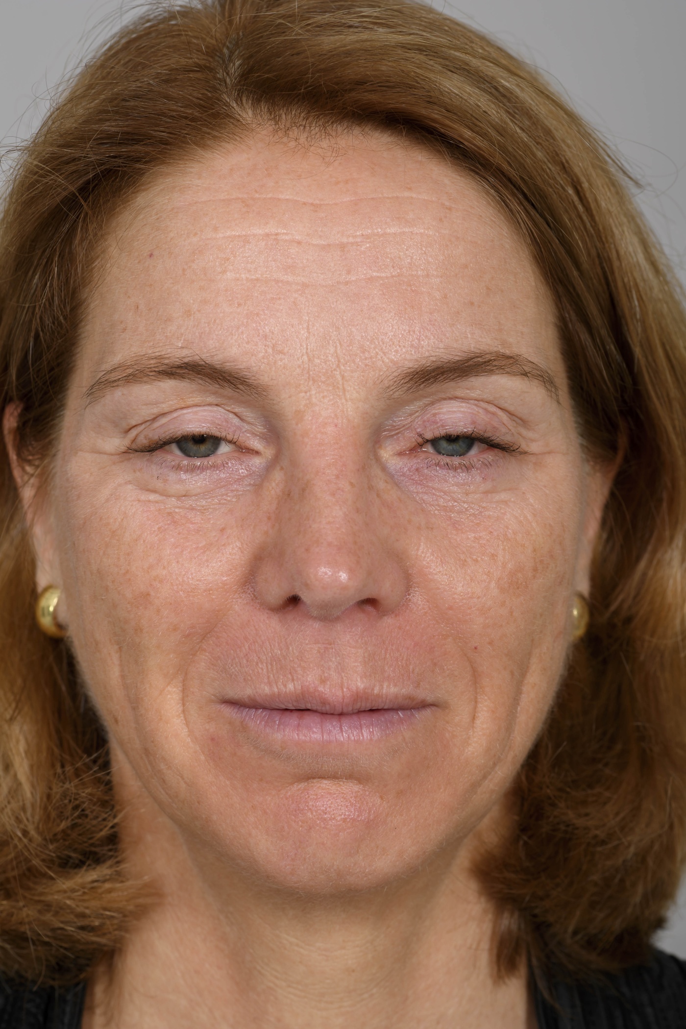 Jarenlang dragen van contactlenzen kan leiden tot ptosis