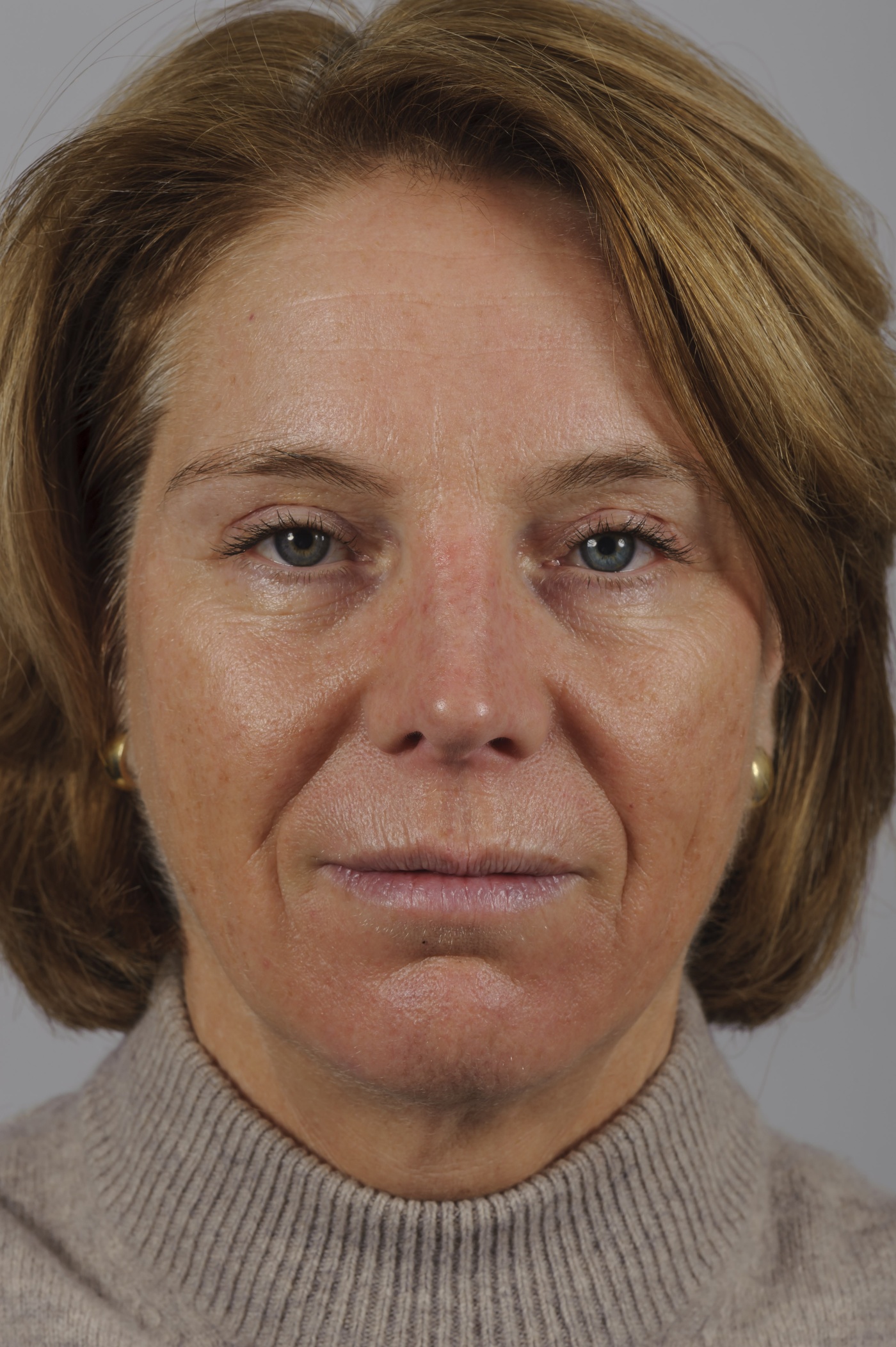 Long-term wear of contact lenses can lead tot ptosis