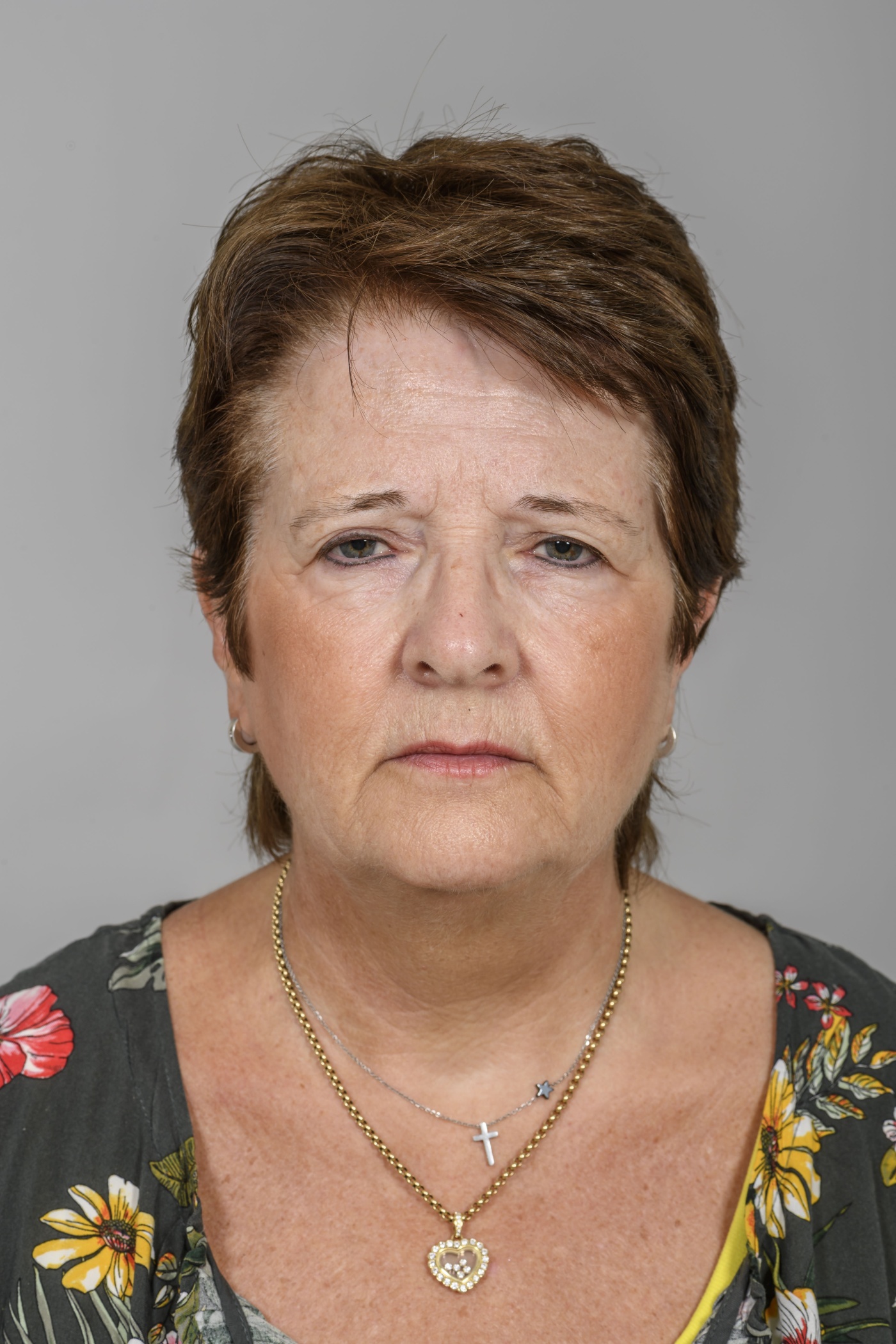 Zonder ooglidcorrectie leidt de voorhoofdslift tot een natuurlijk resultaat