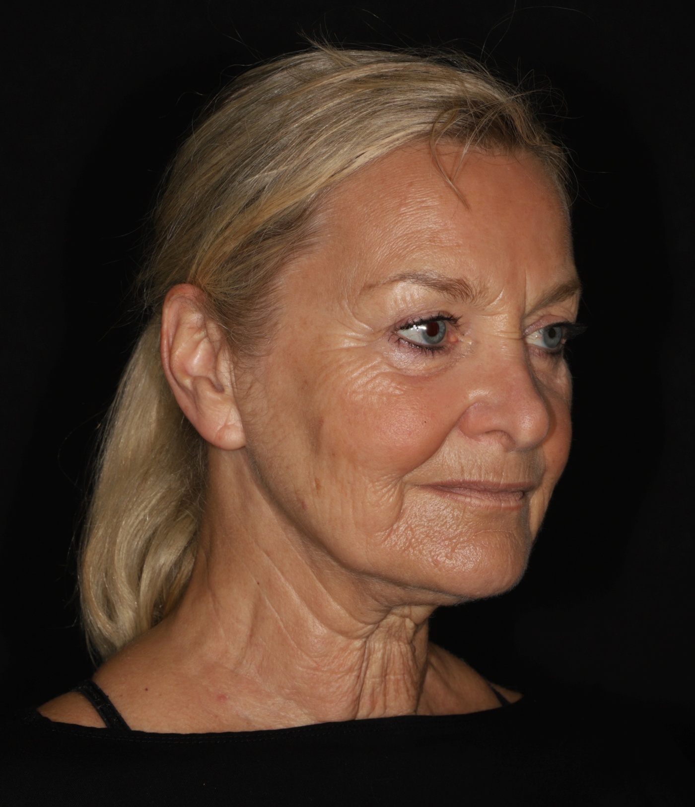 Face- en halslift (1).jpg