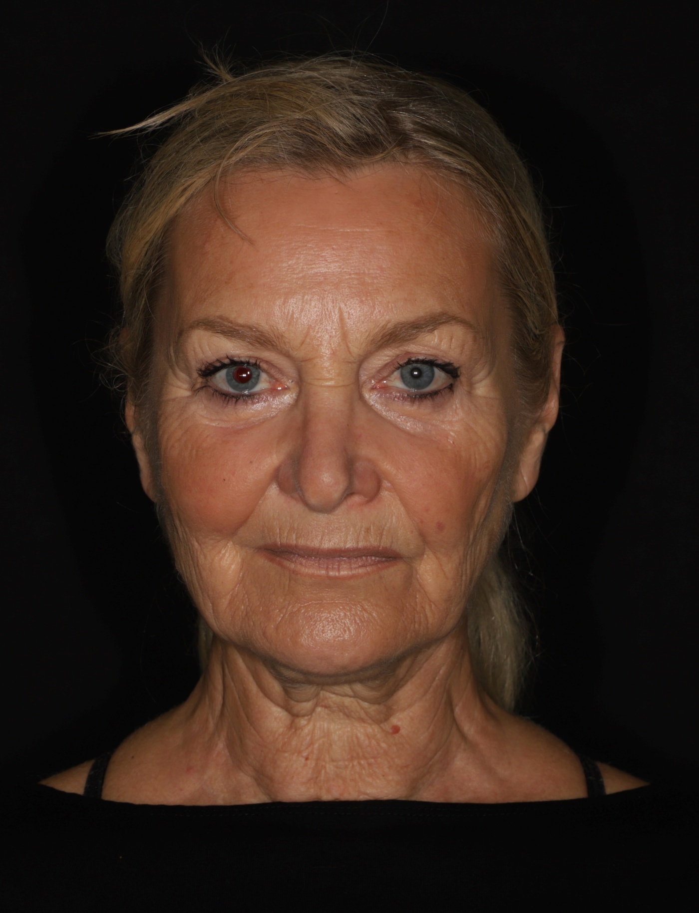 Face- en halslift (1).jpg