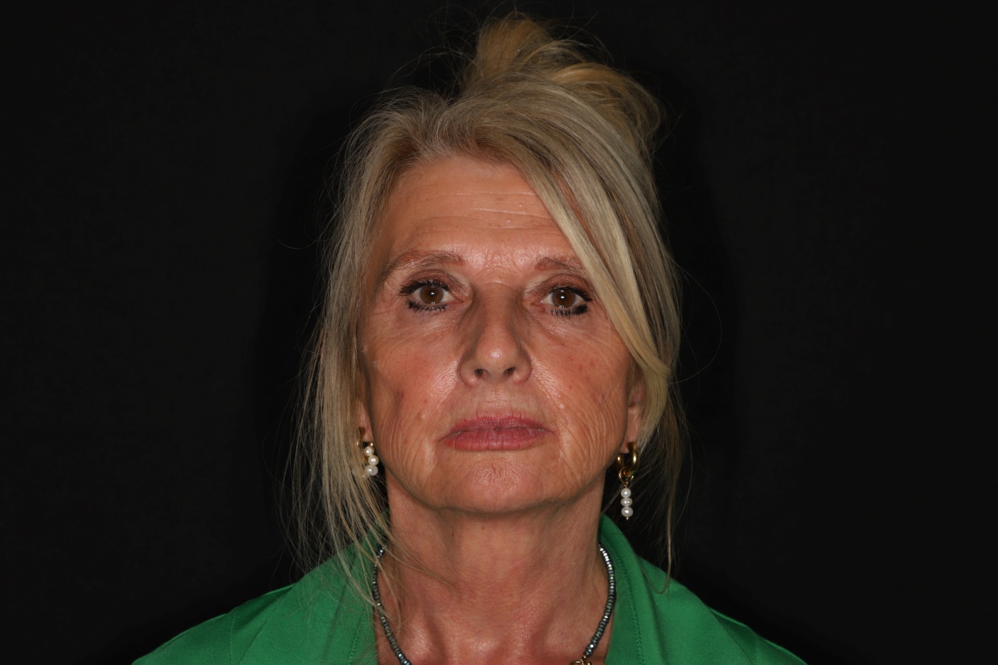 Lipofilling can be added tot the facelift in order to improve the texture of the skin