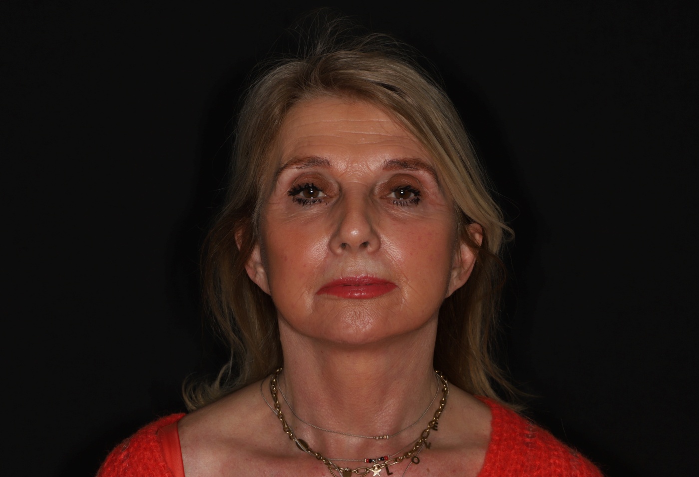Facelift in combinatie met lipofilling ter verbetering van de textuur van de huid
