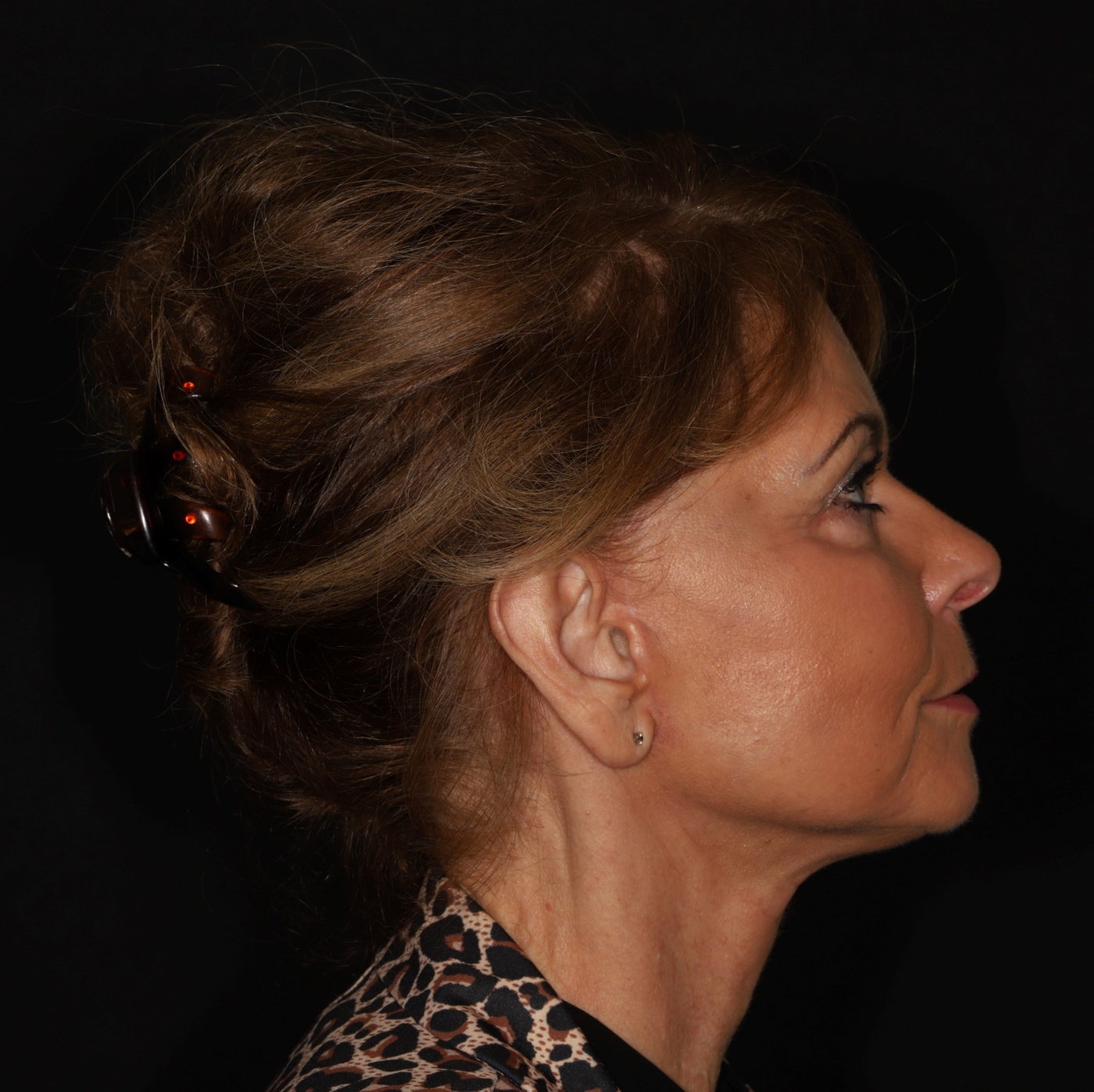 The scar lies behind the hairline of the sideburn