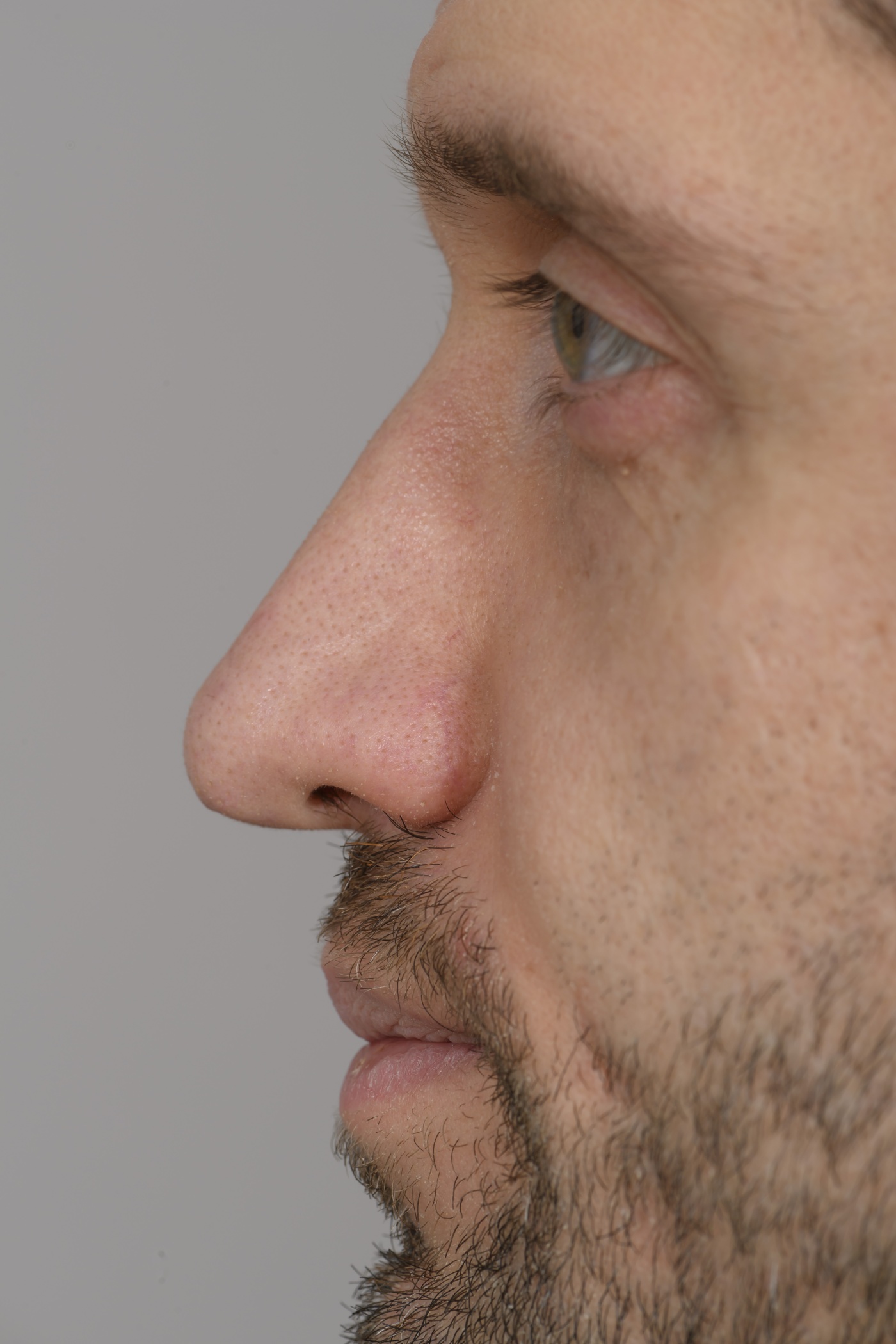 Straightening the dorsum and improving projection